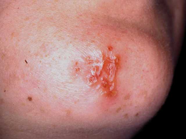 Herpes Simplex - Dermatology Consultants - Skin Secrets